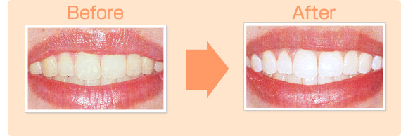 施術前、後の口元の写真ホワイトニング施術前と比べると白さの違いは歴然。